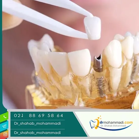 نحوه در آوردن روکش ایمپلنت